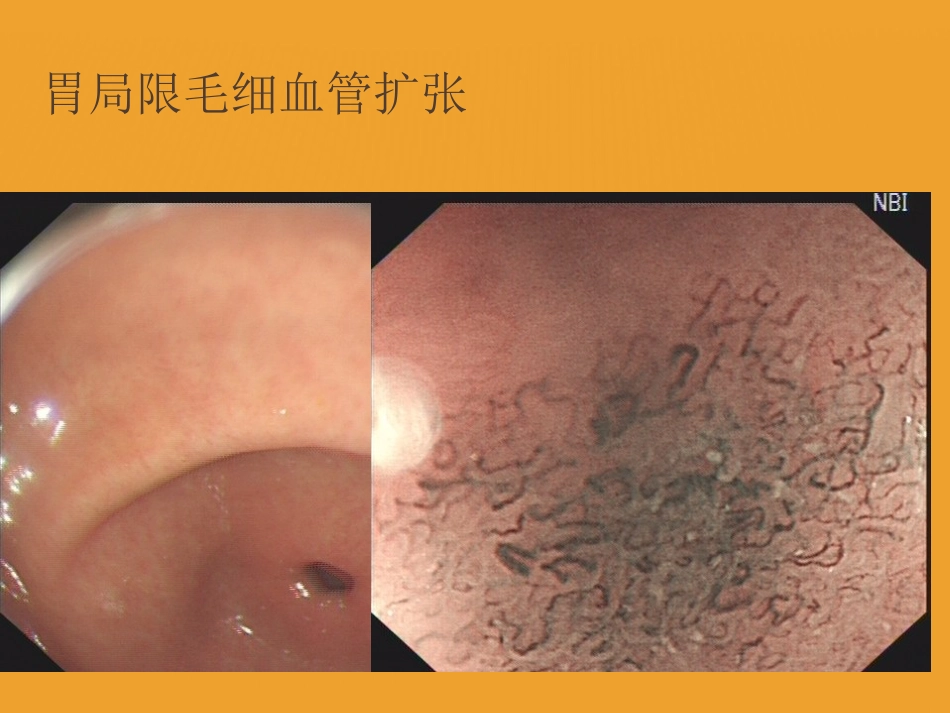 NBI-ME诊断早期胃癌技巧_第7页