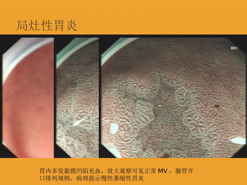 NBI-ME诊断早期胃癌技巧_第8页