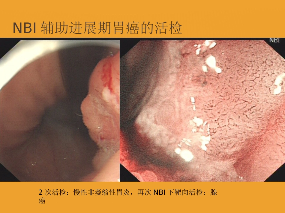 NBI-ME诊断早期胃癌技巧_第9页