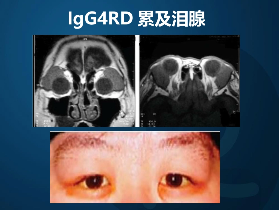 igg相关性胰腺炎_第15页