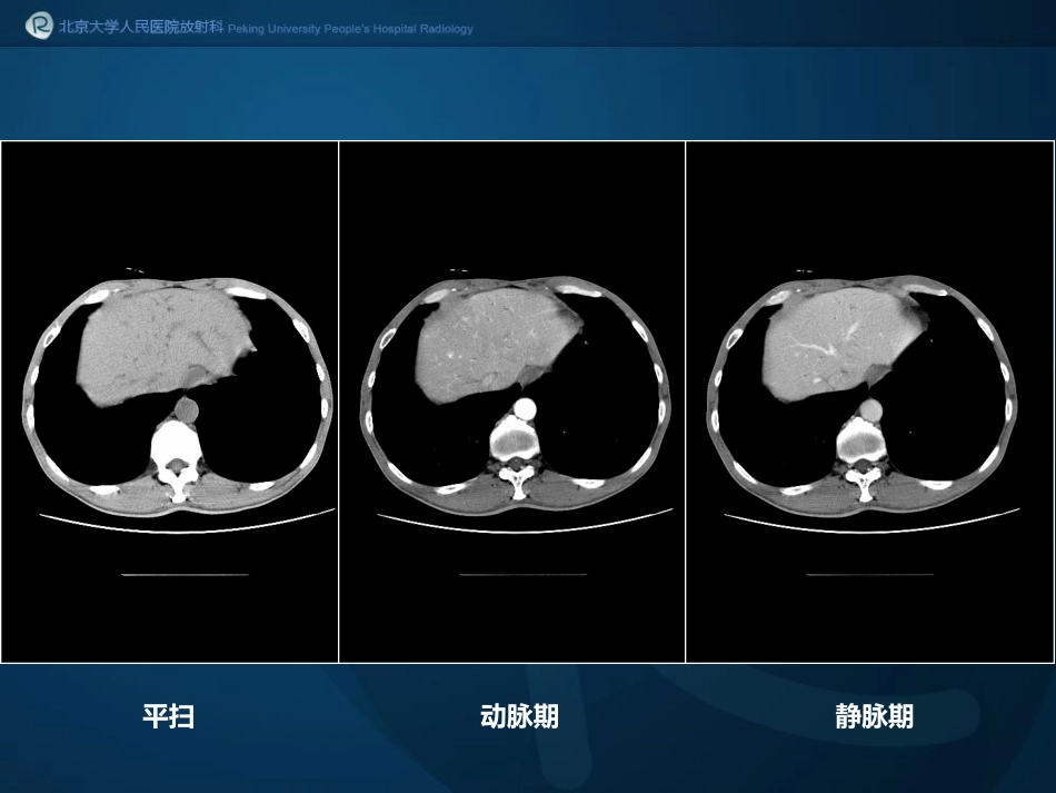 igg相关性胰腺炎_第3页
