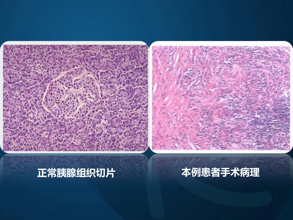 igg相关性胰腺炎_第9页