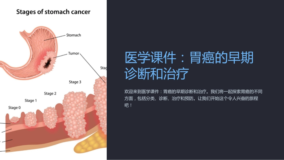 《医学课件胃癌的早期诊断和治疗》_第1页