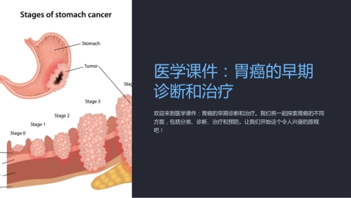 《医学课件胃癌的早期诊断和治疗》