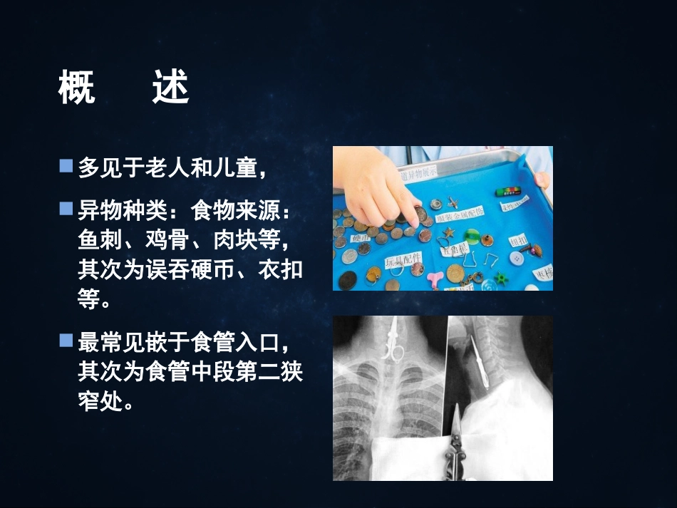 《食管疾病》ppt课件_第10页