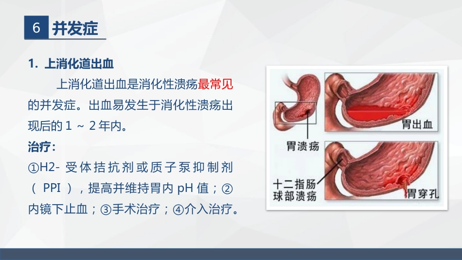 胃溃疡的业务学习_第11页