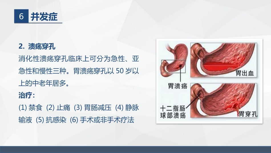 胃溃疡的业务学习_第12页