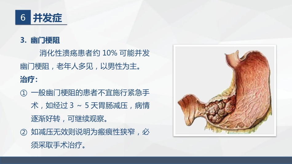 胃溃疡的业务学习_第13页