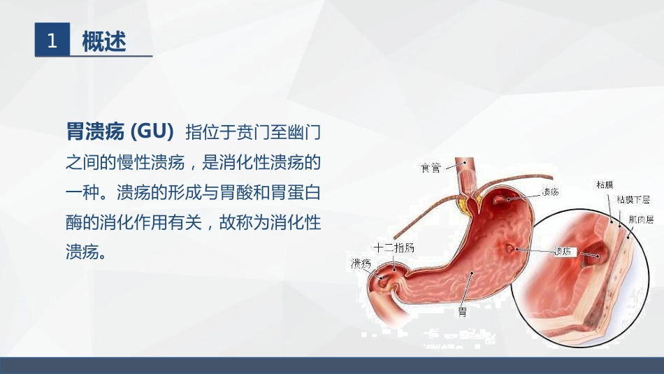胃溃疡的业务学习_第4页