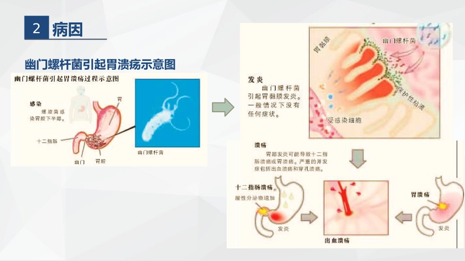 胃溃疡的业务学习_第6页