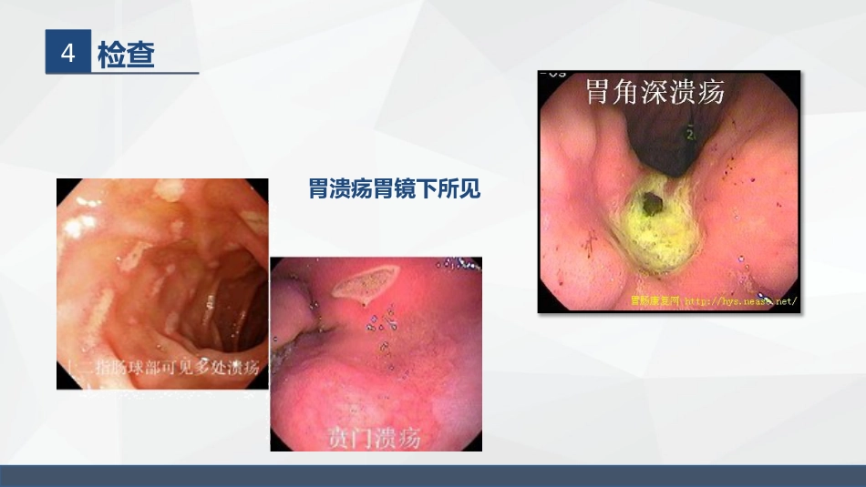 胃溃疡的业务学习_第9页