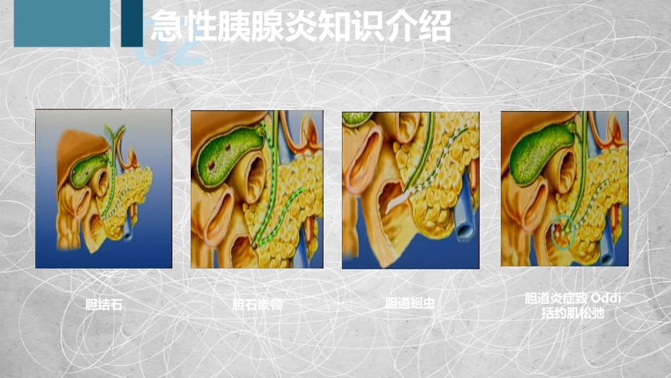 急性胰腺炎护理查房-2_第13页