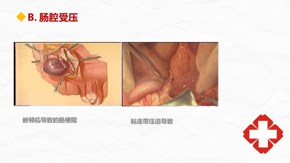 肠梗阻护理查房_第10页