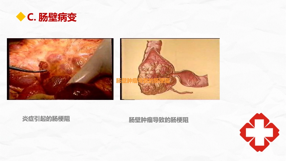 肠梗阻护理查房_第11页