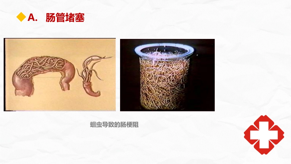 肠梗阻护理查房_第9页