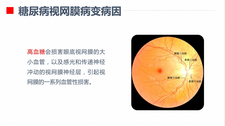 内分泌科-糖尿病视网膜病变患者护理查房_第5页