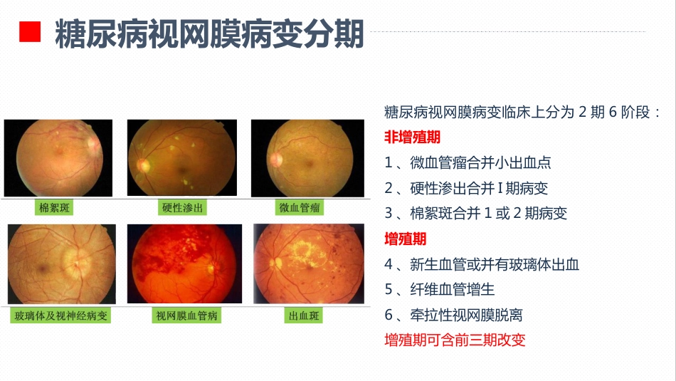 内分泌科-糖尿病视网膜病变患者护理查房_第6页