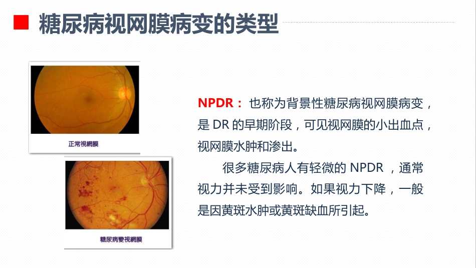 内分泌科-糖尿病视网膜病变患者护理查房_第8页