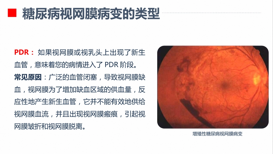 内分泌科-糖尿病视网膜病变患者护理查房_第9页
