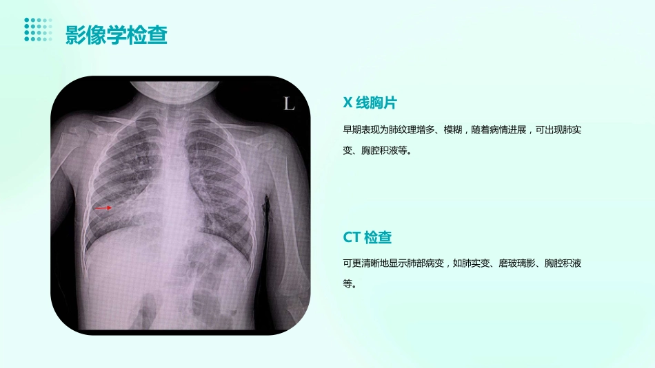 肺炎的临床诊疗指南及药物应用建议_第10页