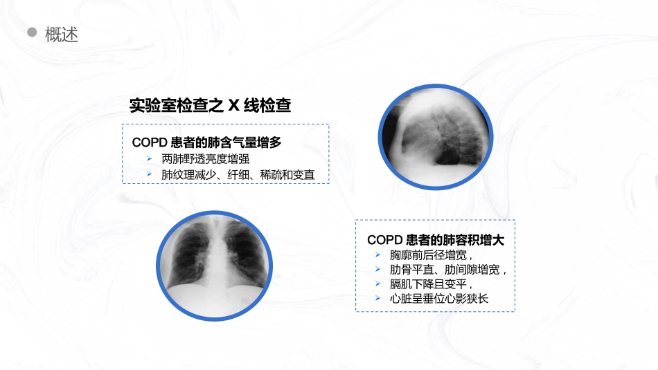 COPD慢阻肺病人护理查房_第14页