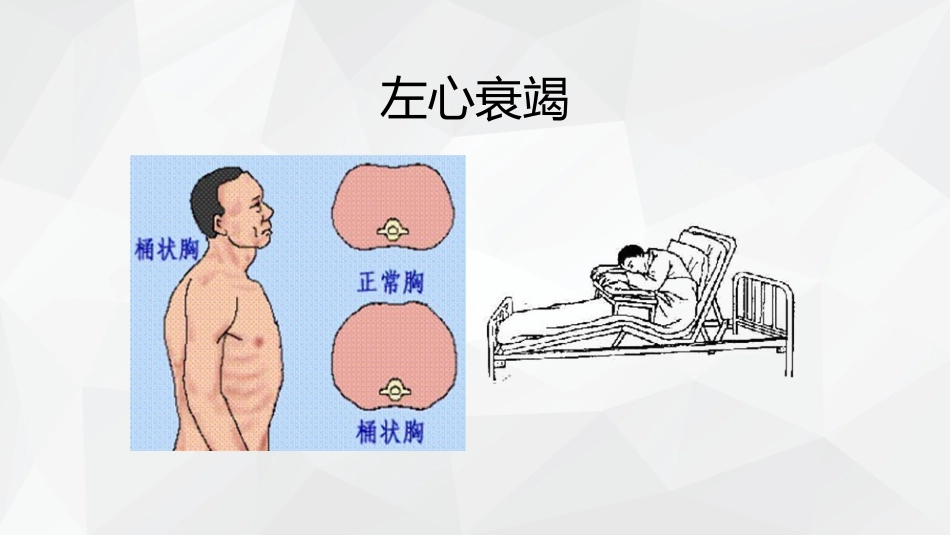 心力衰竭护理查房_第11页