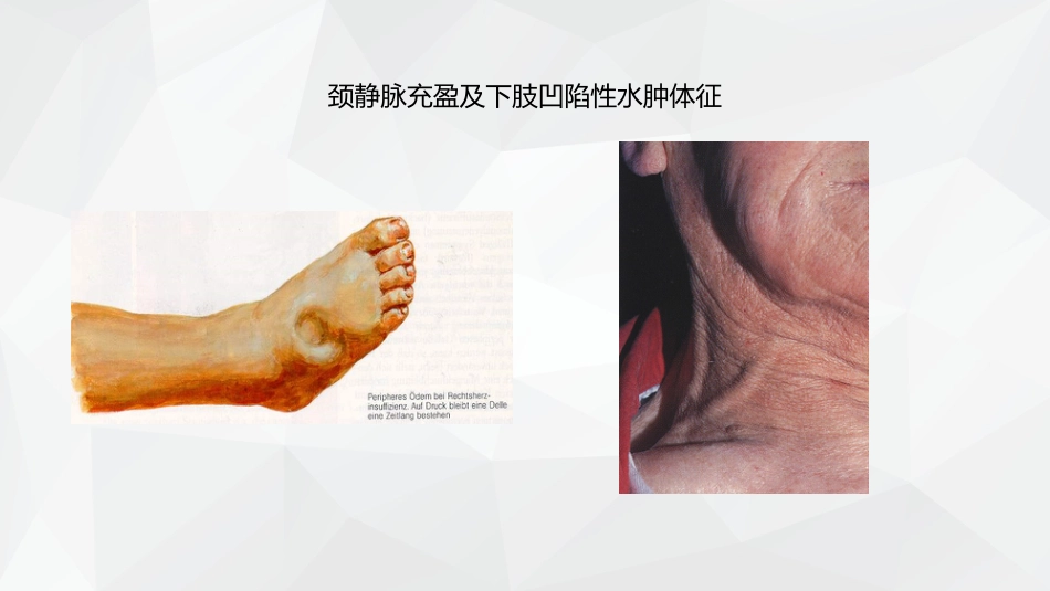 心力衰竭护理查房_第13页