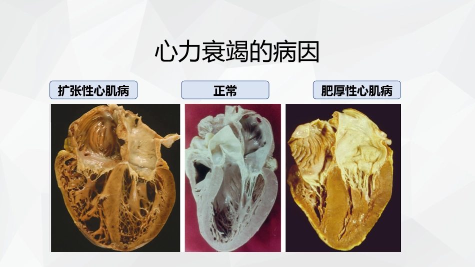 心力衰竭护理查房_第6页