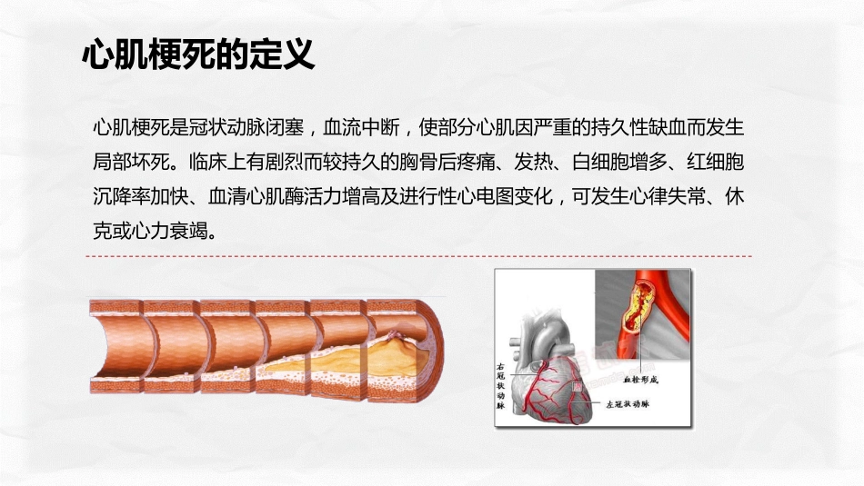 心肌梗塞个案护理_第10页