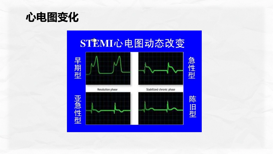 心肌梗塞个案护理_第13页