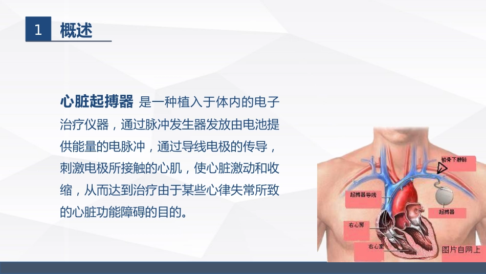 永久起搏器的业务学习_第4页