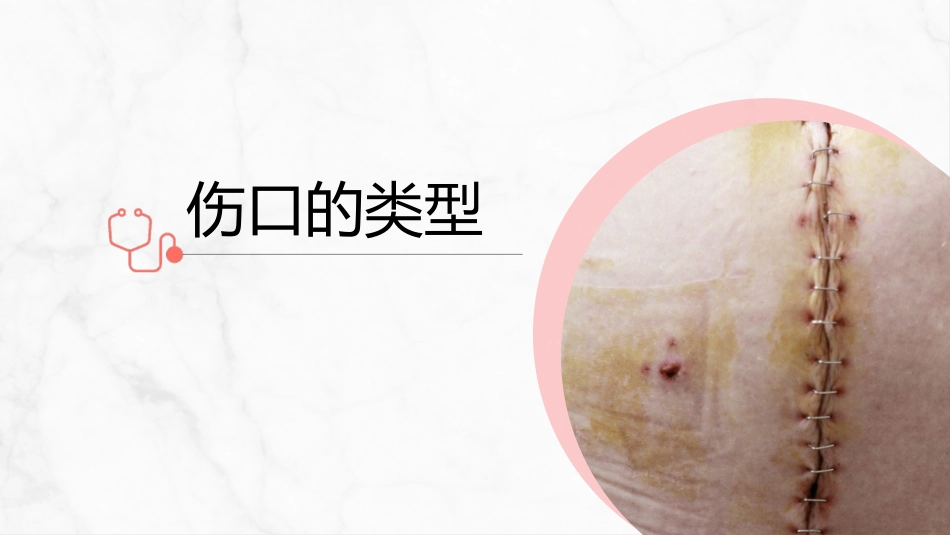 伤口护理_第13页