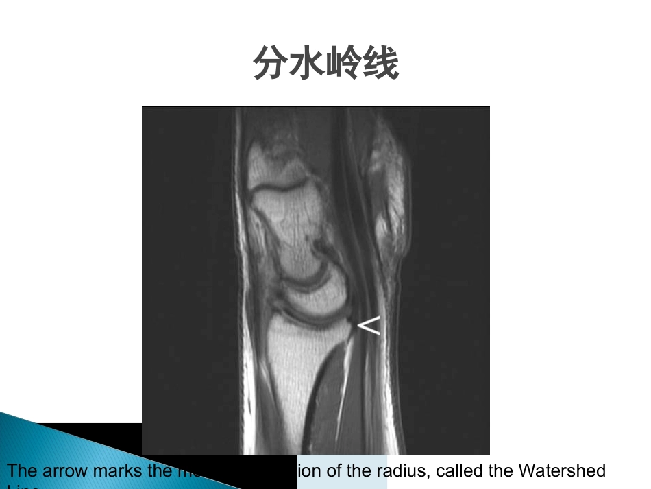 创伤中心：桡骨远端骨折课件_第10页