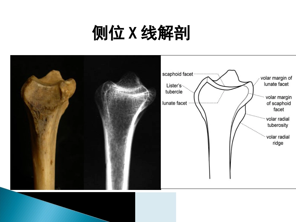 创伤中心：桡骨远端骨折课件_第11页