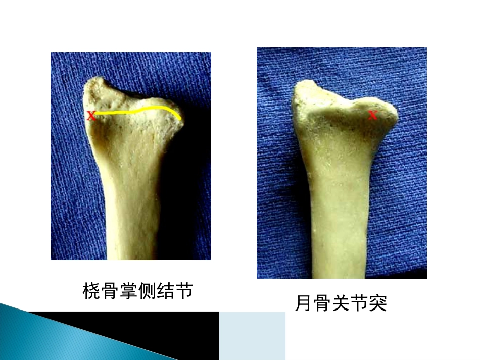 创伤中心：桡骨远端骨折课件_第7页