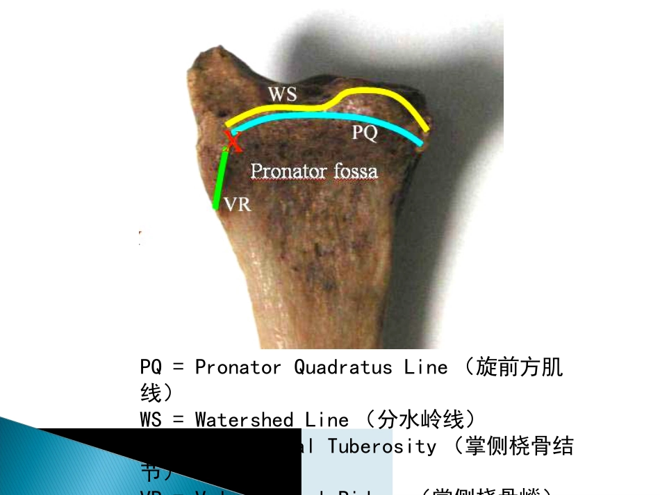 创伤中心：桡骨远端骨折课件_第8页