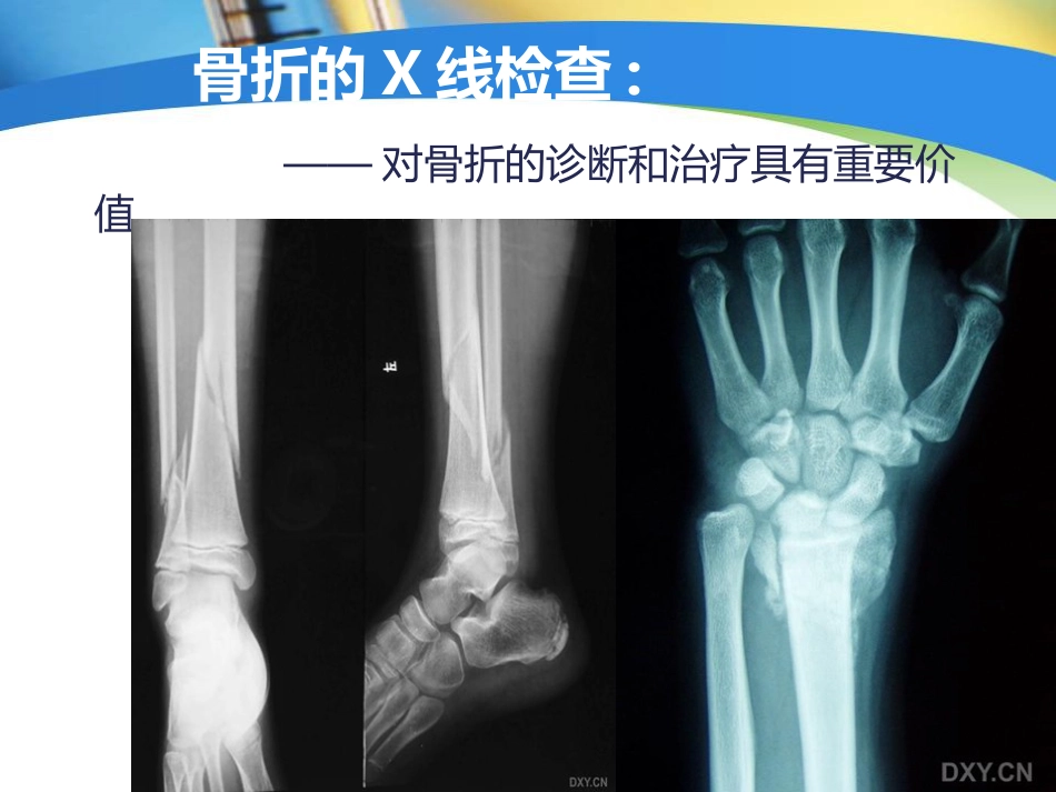 创伤中心：骨科创伤的急救处理_第11页