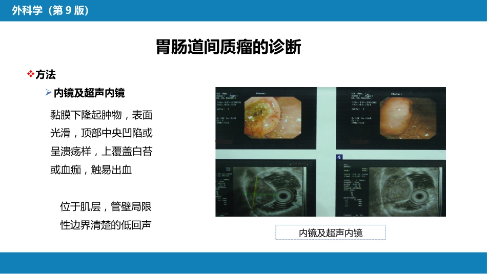 胃十二指肠疾病 第三节（二）胃肠道间质瘤_第15页