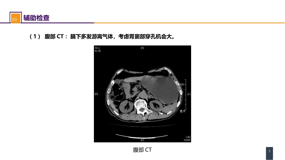 胃十二指肠疾病 案例分析-胃十二指肠溃疡伴穿孔_第5页