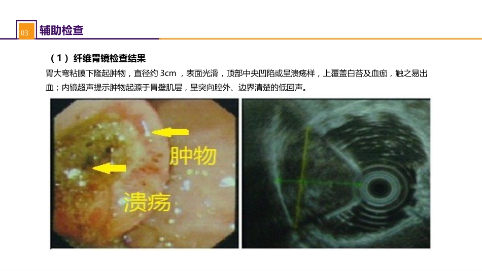 胃十二指肠疾病 案例分析-胃间质瘤_第5页