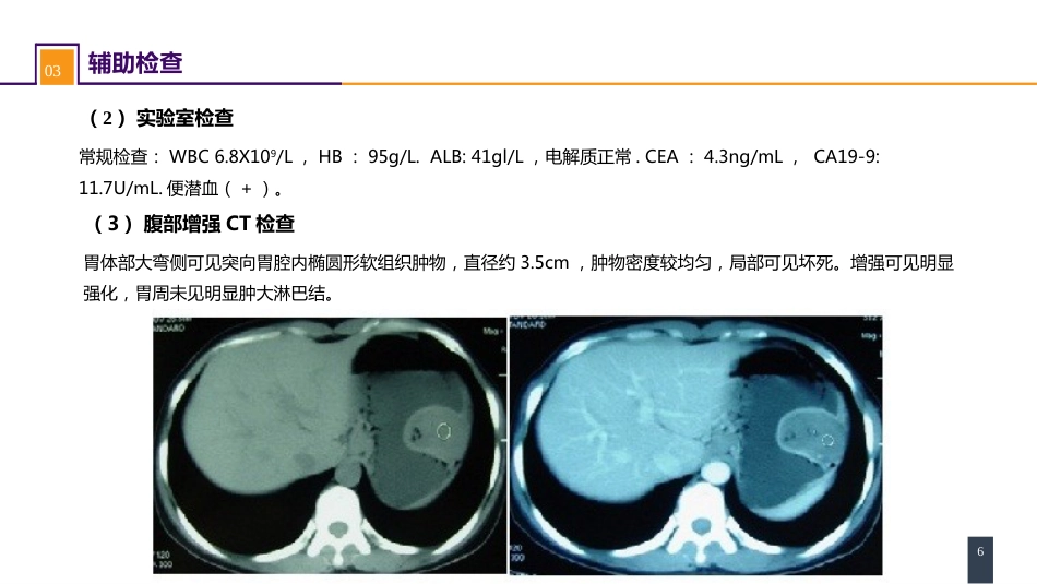 胃十二指肠疾病 案例分析-胃间质瘤_第6页