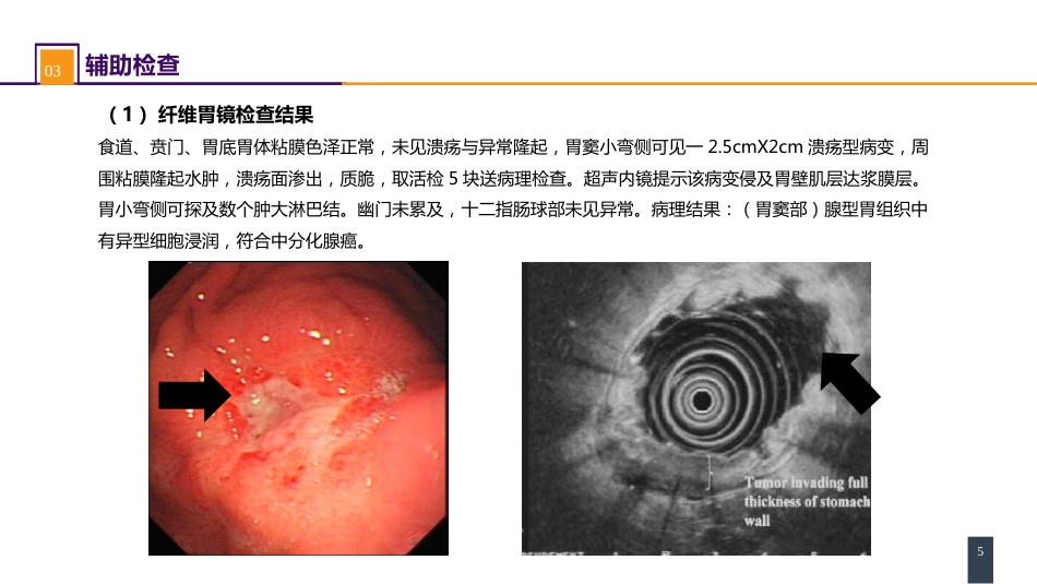 胃十二指肠疾病 案例分析-胃癌_第5页