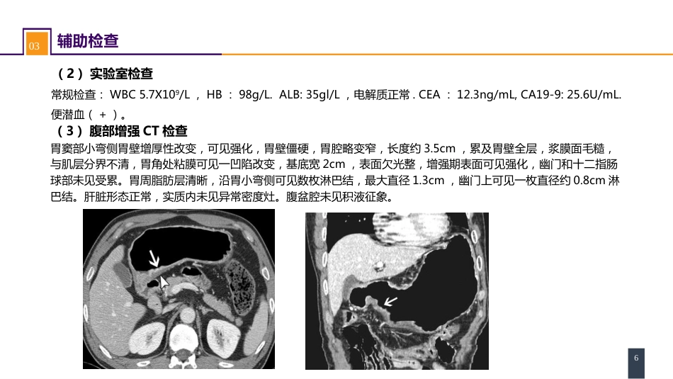 胃十二指肠疾病 案例分析-胃癌_第6页