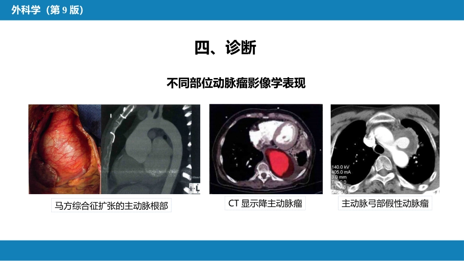外科学：胸主动脉疾病_第14页