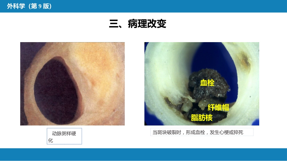 外科学：心脏疾病第三节后天性心脏疾病的外科治疗_第8页