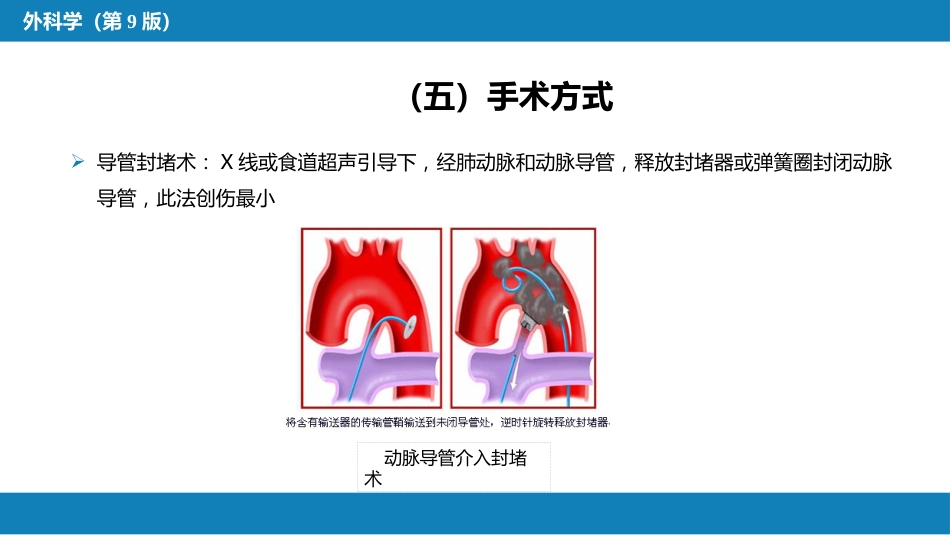 外科学：心脏疾病第二节先天性心脏病的外科治疗_第11页