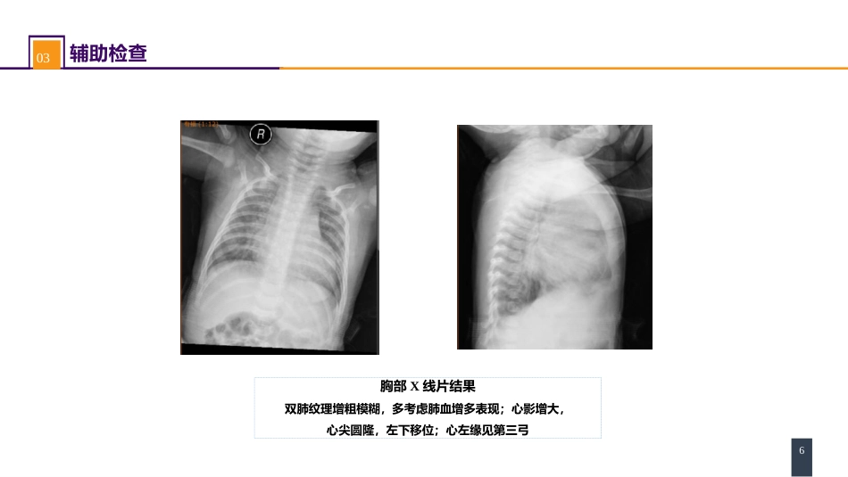 外科学：心脏疾病案例分析-室间隔缺损_第6页