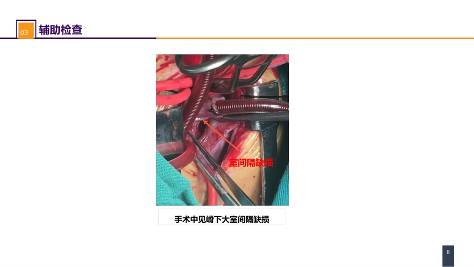 外科学：心脏疾病案例分析-室间隔缺损_第8页