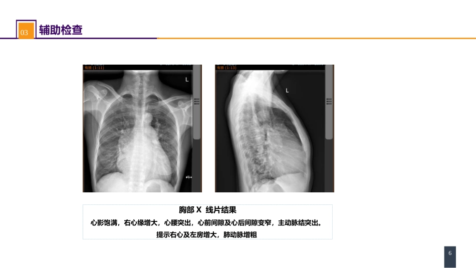 外科学：心脏疾病案例分析-房间隔缺损_第6页