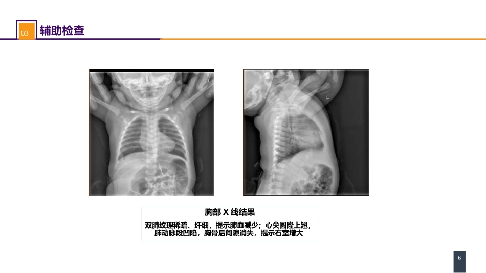 外科学：心脏疾病案例分析-法洛四联症_第6页
